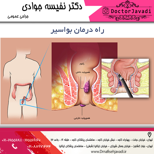 راه درمان بواسیر