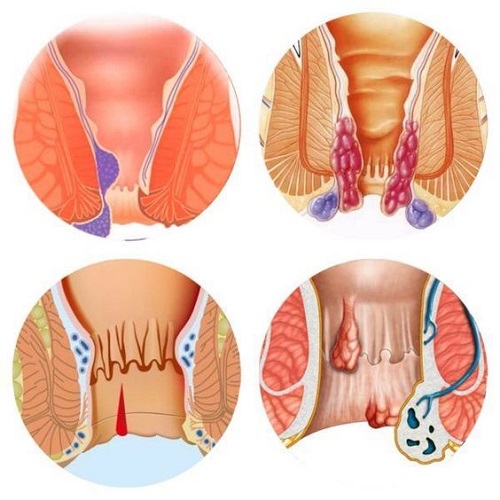 کلینیک خونریزی مقعد